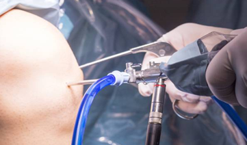 Arthroscopy